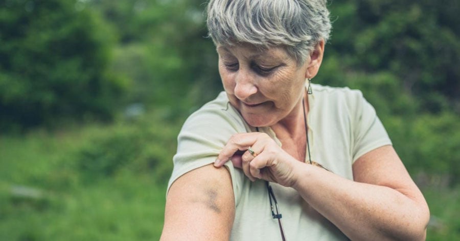 What to Know About Bruising Skin in the Elderly